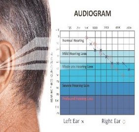 audiogram
